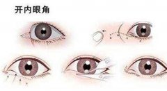 開內(nèi)眼角和外眼角的區(qū)別？