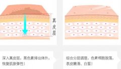 像素激光和點(diǎn)陣激光的不同之處是什么？