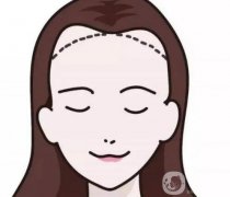 脫發(fā)際線產(chǎn)生的副作用如何避免？