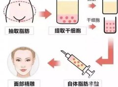 自體脂肪填充有什么優(yōu)勢？