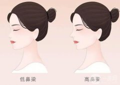 為什么隆鼻會(huì)感染，原因是什么?