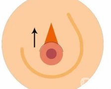 乳暈手術(shù)的特點(diǎn)是什么?需要注意哪些事項(xiàng)？