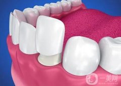 做了烤瓷牙可以做核磁共振嗎？