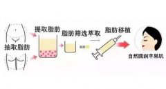 自體脂肪填充的缺點(diǎn)有哪些？