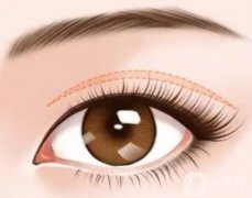 夏天切雙眼皮會(huì)引起炎癥嗎？