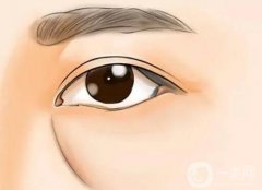 填充淚溝失敗怎么辦？玻尿酸填充淚溝嗎？