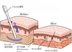 水動(dòng)力吸脂后需要多長(zhǎng)時(shí)間才能開始工作？
