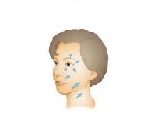 拉皮手術(shù)有哪些后遺癥？有哪些好處？