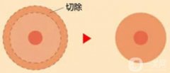 乳暈縮小手術(shù)對(duì)身體影響大不大？