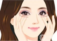 哪個(gè)時(shí)候割雙眼皮好?