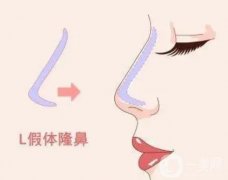 隆鼻假體取出后恢復需要多長時間？取出隆鼻假體的價格？