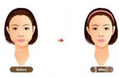 水動(dòng)力吸脂瘦臉有嗎，水動(dòng)力吸脂瘦臉的優(yōu)點(diǎn)和缺點(diǎn)？