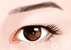 如何判斷是否開(kāi)了眼角呢？