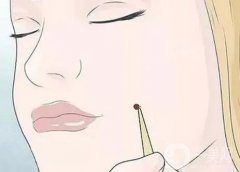 激光點(diǎn)痣后有凹洞怎么辦