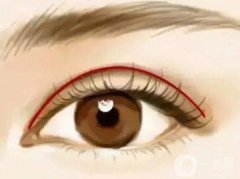 眼部整形的方法有哪些？