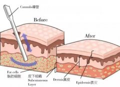 水動(dòng)力吸脂是*性的嗎？可以持續(xù)多久？