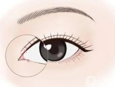 什么方法開眼角果好?開眼角好嗎?