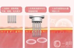 微針美容有哪些風險