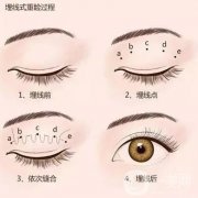埋線雙眼皮感染了該怎么辦
