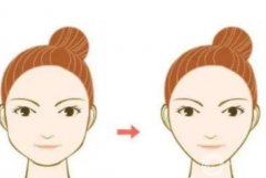 磨骨會(huì)出現(xiàn)下垂的情況嗎？