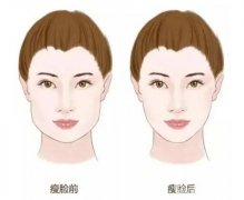 激光溶脂瘦臉有什么副作用？