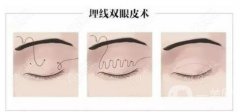 雙眼皮埋線有哪些注意事項(xiàng)？