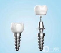 種植牙用的材料有哪些？