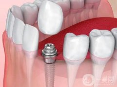 種植牙和鑲牙信息介紹？