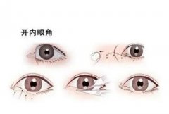 開眼角有可能回縮嗎？開眼角大概要多少錢