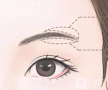 切眉術后的副作用具體有哪些?