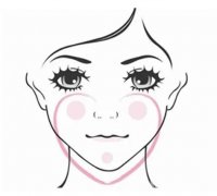 蘋(píng)果肌填充容易出現(xiàn)什么后遺癥？