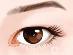 開外眼角為什么不建議做呢，開外眼角的恢復(fù)時(shí)間
