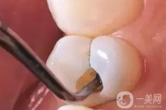 補(bǔ)牙的方法，什么情況需要補(bǔ)牙？