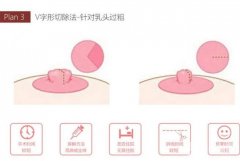 乳頭縮小是否影響母乳喂養(yǎng)，乳頭縮小手術有什么特點？