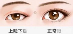 矯正上瞼下垂的怎么樣，有哪些后遺癥？