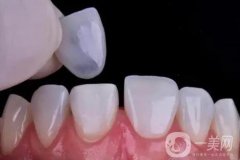 牙齒貼面有哪些類型?