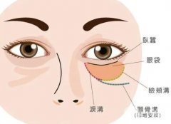 脂肪可以填充臥蠶嗎，注射玻尿酸可以填充臥蠶嗎？