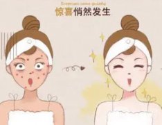 怎么去除臉上的斑點？