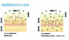 需要多長時間做一次果酸換膚？