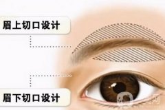 提眉可以做多少次？提眉手術(shù)的果有哪些？