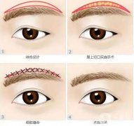 切眉術(shù)的切口在什么地方？