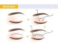 埋線雙眼皮會(huì)出現(xiàn)哪些異常反應(yīng)？