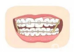 有哪些因素影響牙齒矯正的價(jià)格？