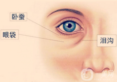 眼袋抽脂的后遺癥是什么?