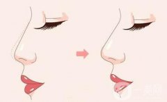 微創(chuàng)隆鼻術(shù)后出現(xiàn)嗅覺(jué)衰竭是否正常？