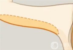 手臂抽脂有什么原理，會(huì)反彈嗎？