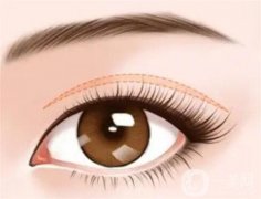 全切雙眼皮后化妝需要等多久？為什么不能化妝