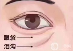 切開眼袋后有什么需要注意？