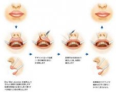 重唇修正前的注意事項?重唇修正后的注意事項?