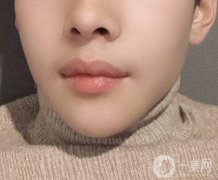 嘴唇外翻怎么矯正?唇外翻矯正術(shù)前的準備有哪些?